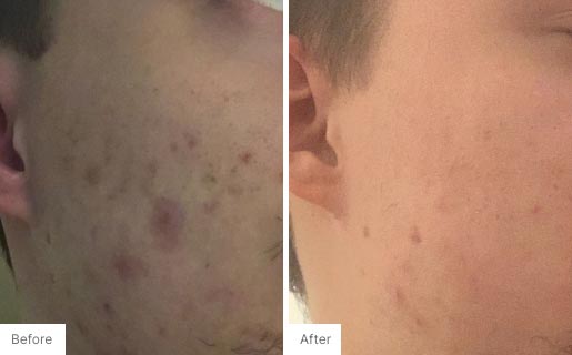 1 - Before and After Real Results photo of a man's use of Neora's Acne Complexion Treatment Pads