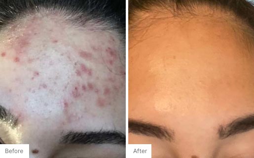 4 - Before and After Real Results photo of a woman's use of Neora's Acne Complexion Treatment Pads