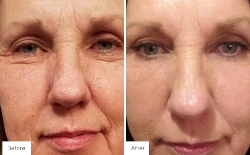 10 - Before and After Real Results of Age IQ Day Cream on a woman's face