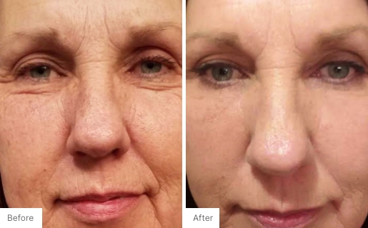 10 - Before and After Real Results photo of a woman's face.